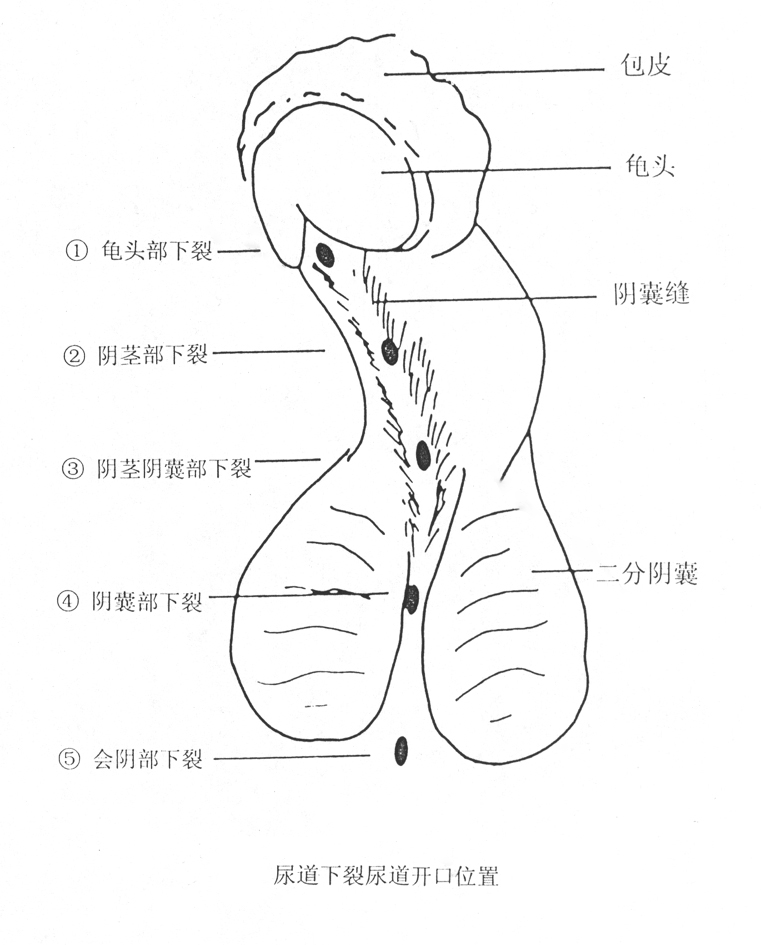 男孩尿道口囊肿图片