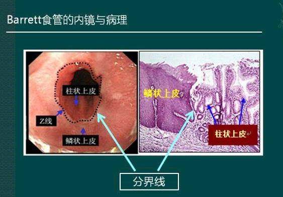 巴雷特食管(Barrett食管)是什么意思_管晓勇_副主任医师_爱问健康