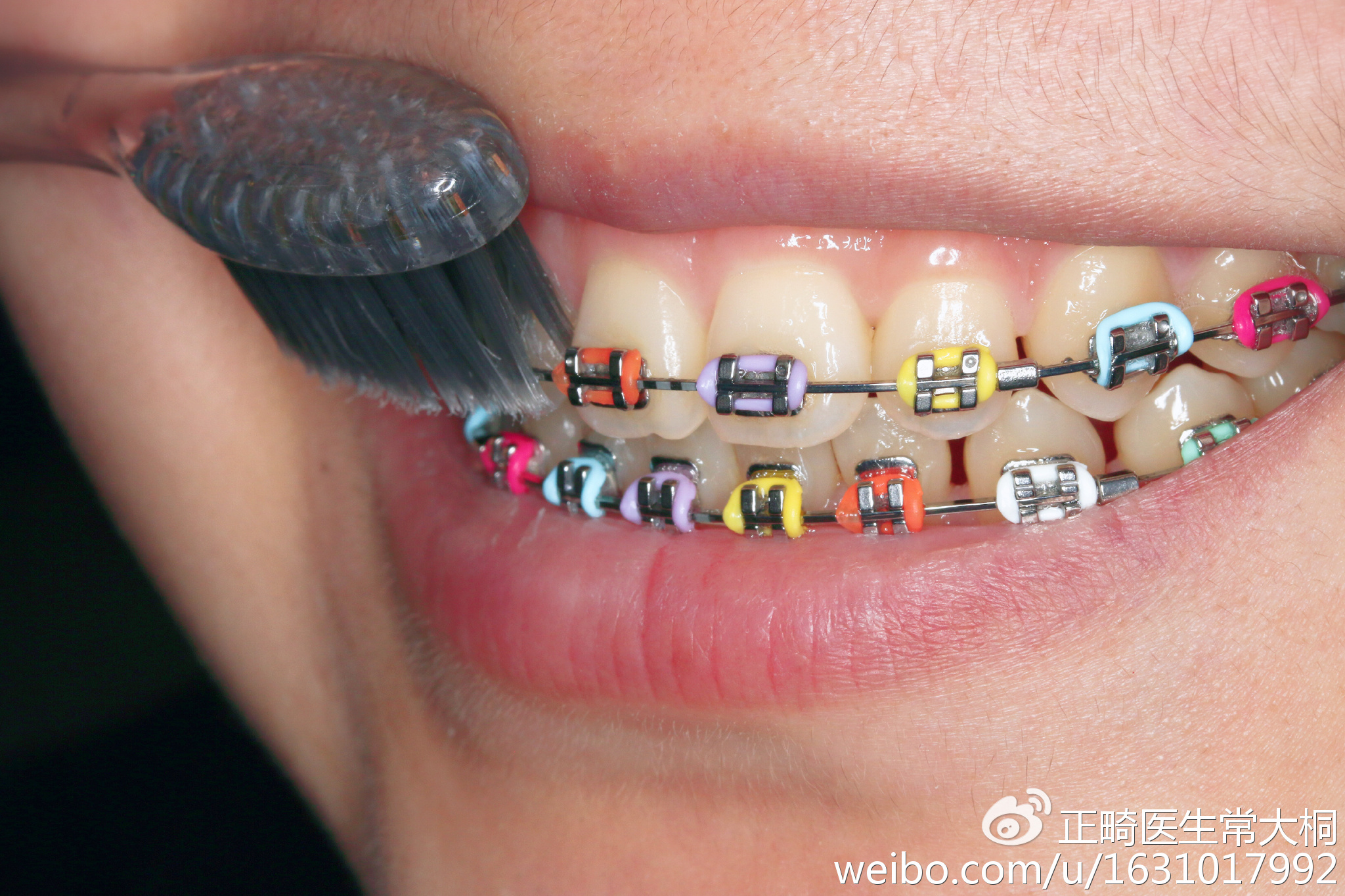 医生常说矫正牙齿更要把牙刷好,but how?