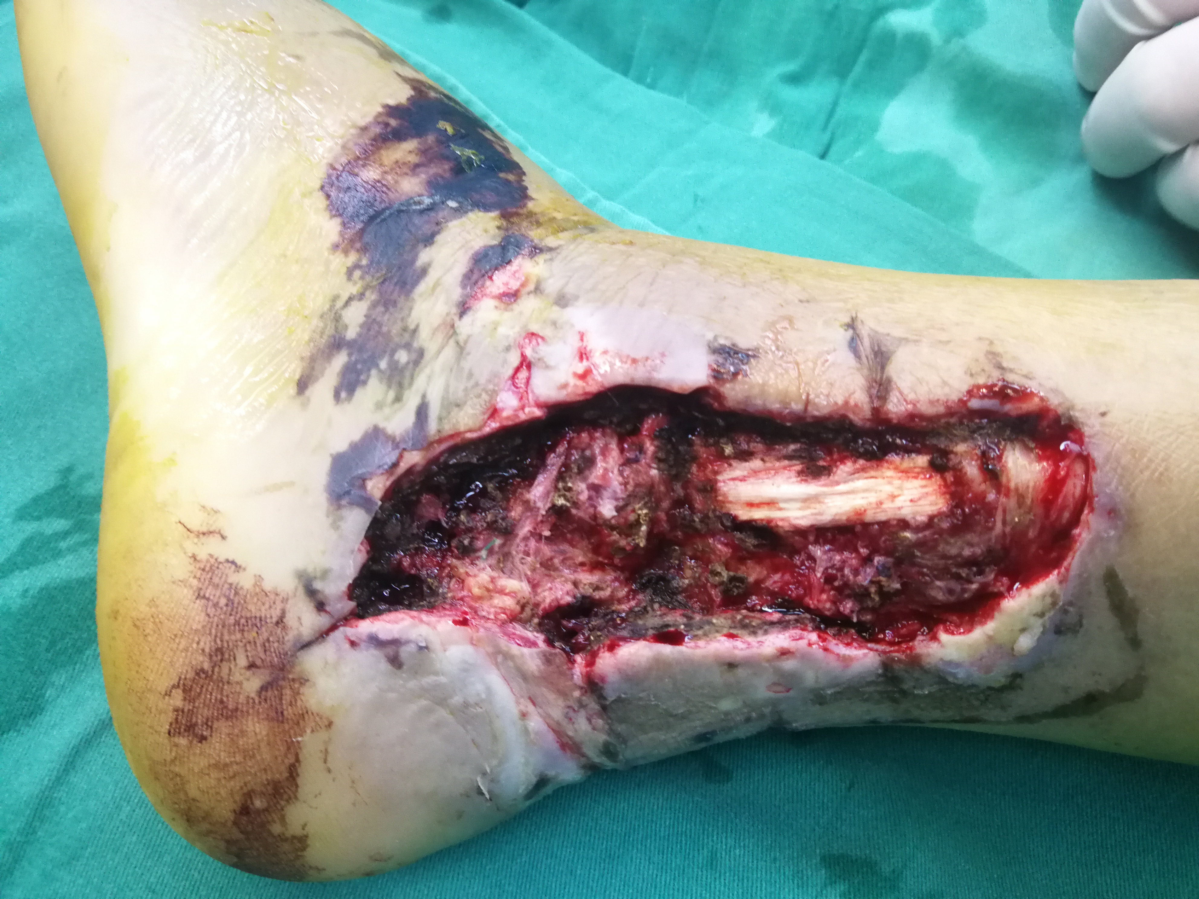 外踝上皮瓣修复创面