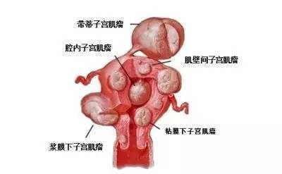 多发性子宫肌瘤