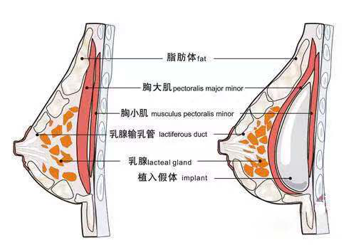 扁平胸测量标准图片