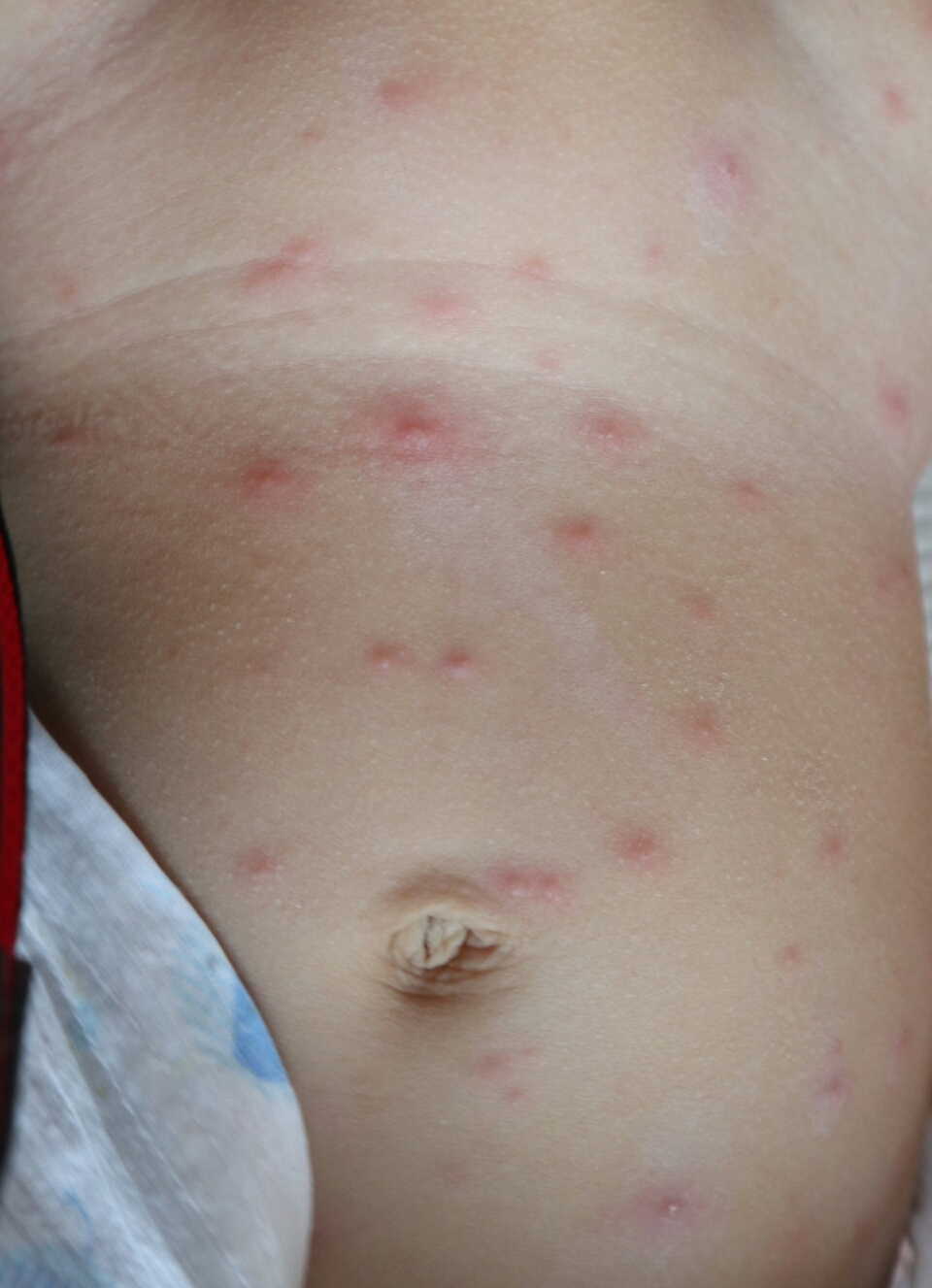 小儿水痘初期症状图片