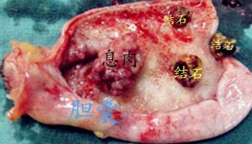 胆囊息肉有什么症状图片