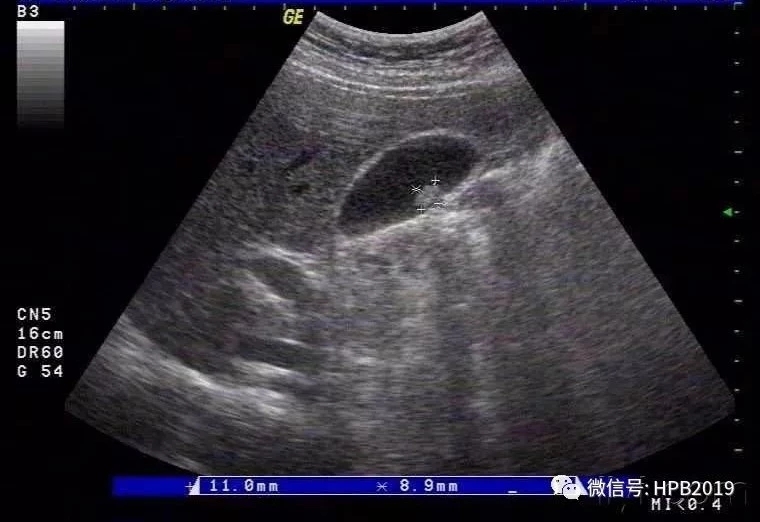 “真假”胆囊息肉如何鉴别？_段斌炜_副主任医师_爱问健康