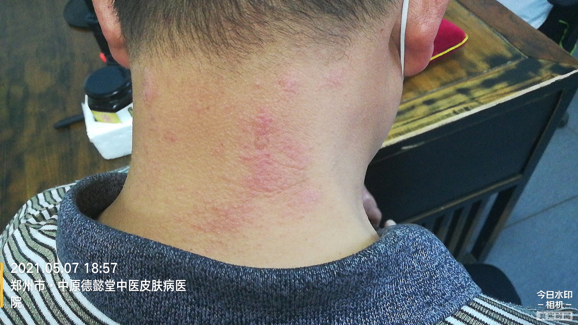 【临床医案】神经性皮炎治疗医案解析:_李志忠_主治医师_爱问健康