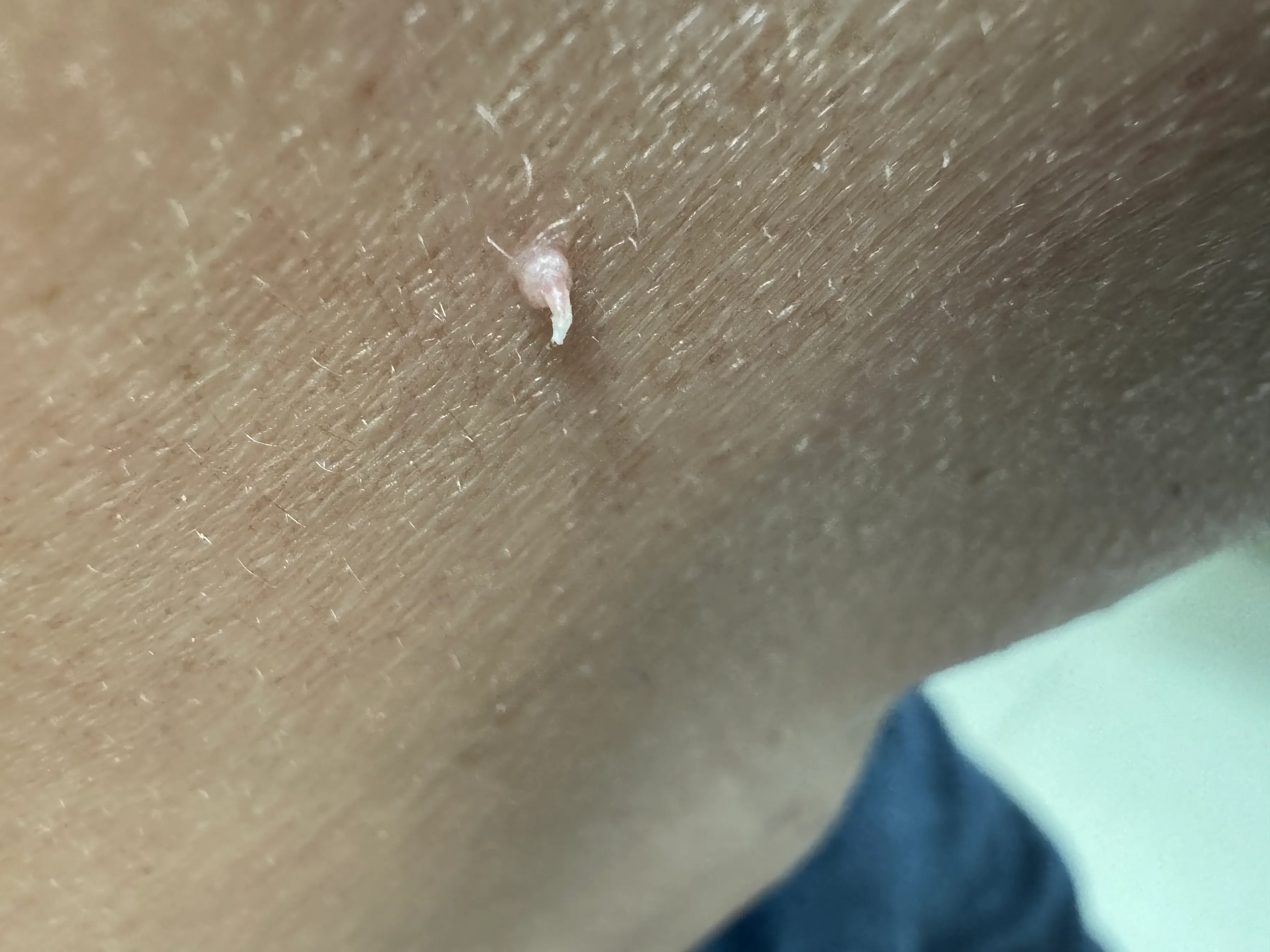 HPV感染在皮肤上的八大表现_朱敏刚_主任医师_爱问健康
