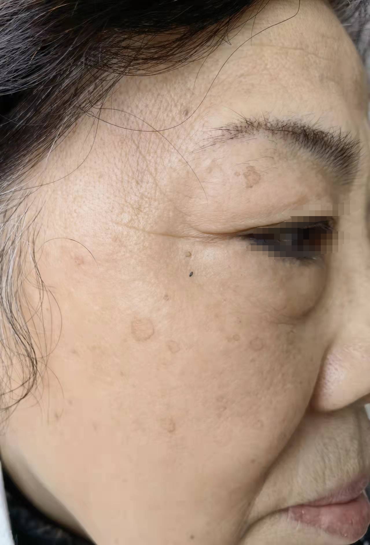 脸上的黑圈圈是老年斑?