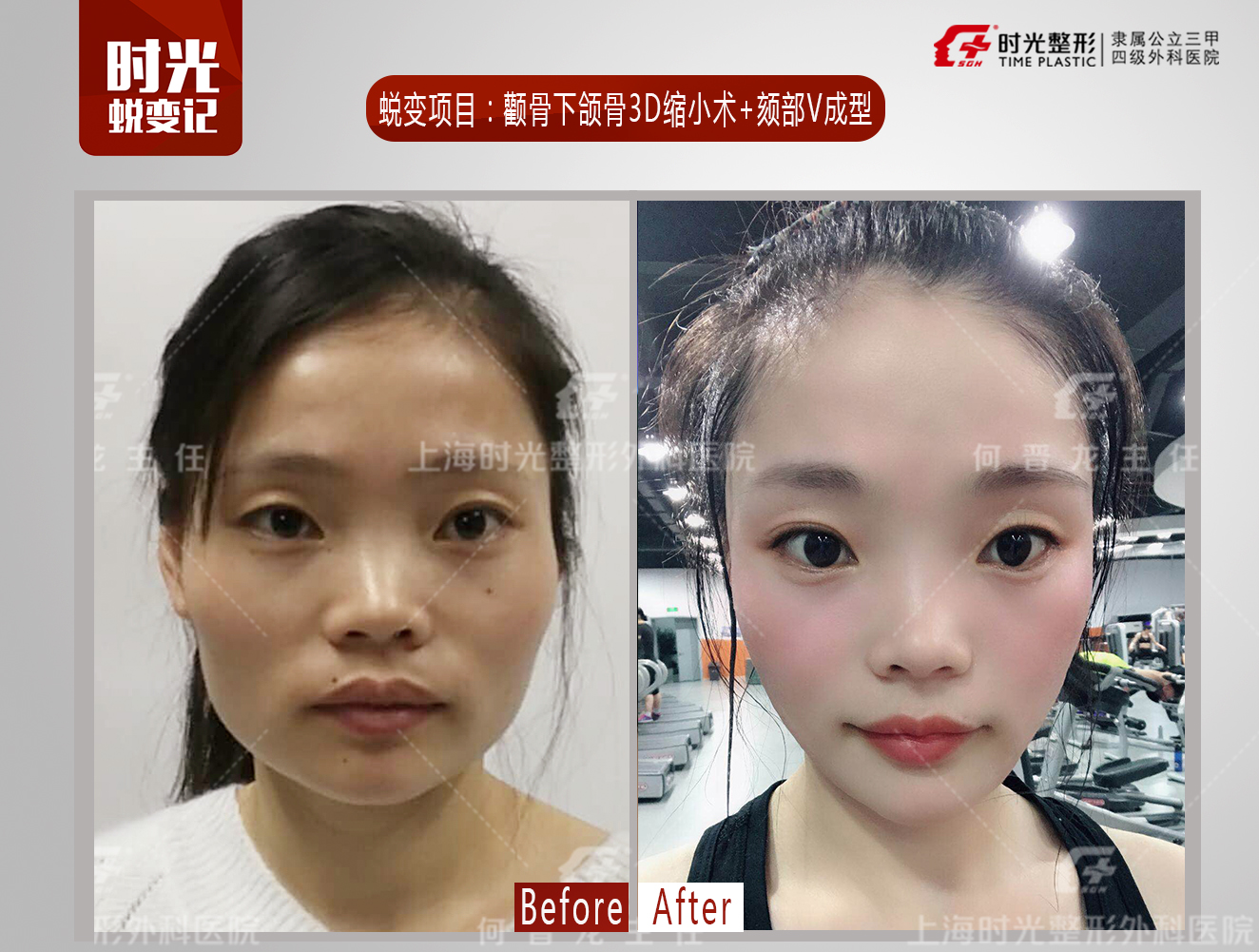 浅谈颏v —截骨前移术_何晋龙_副主任医师_爱问健康