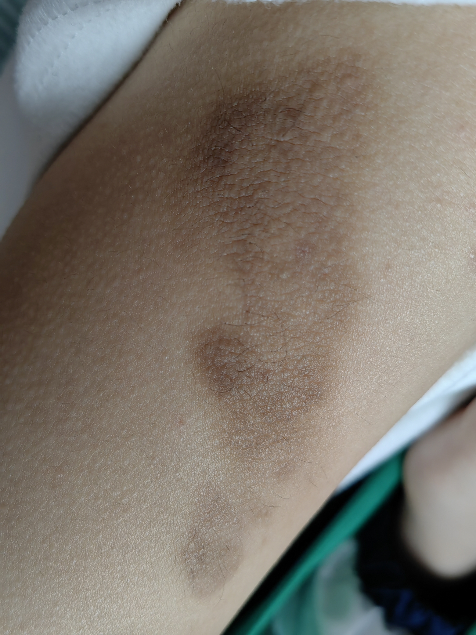 色素性毛表皮痣,长啥样?_朱敏刚_主任医师_爱问健康