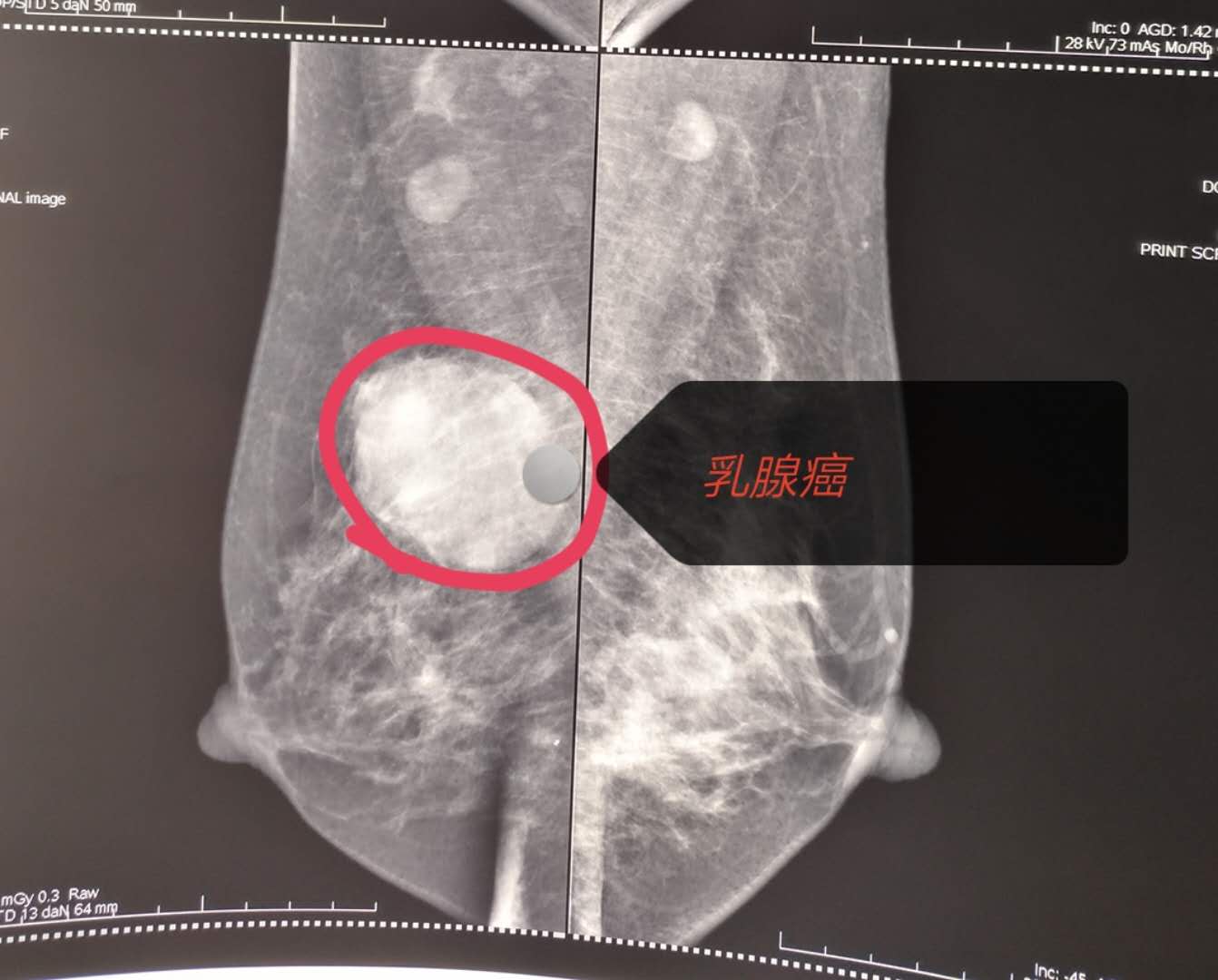wow,长知识了,6厘米乳腺癌海扶也能保乳治疗!