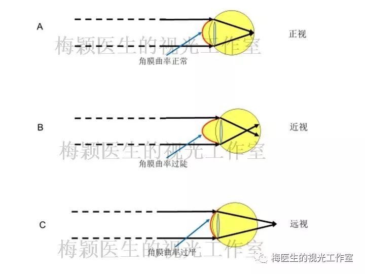图1 眼的屈光状态由角膜曲率,眼轴,晶状体屈光力决定眼轴增长使眼球