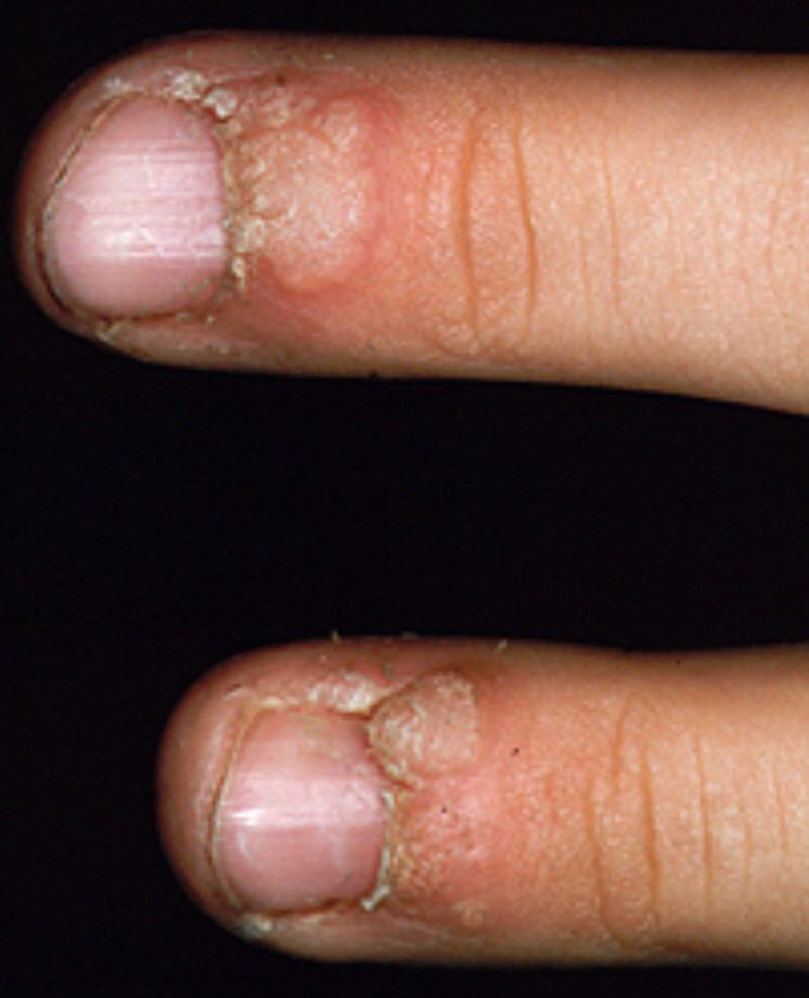 指甲纤维瘤图片