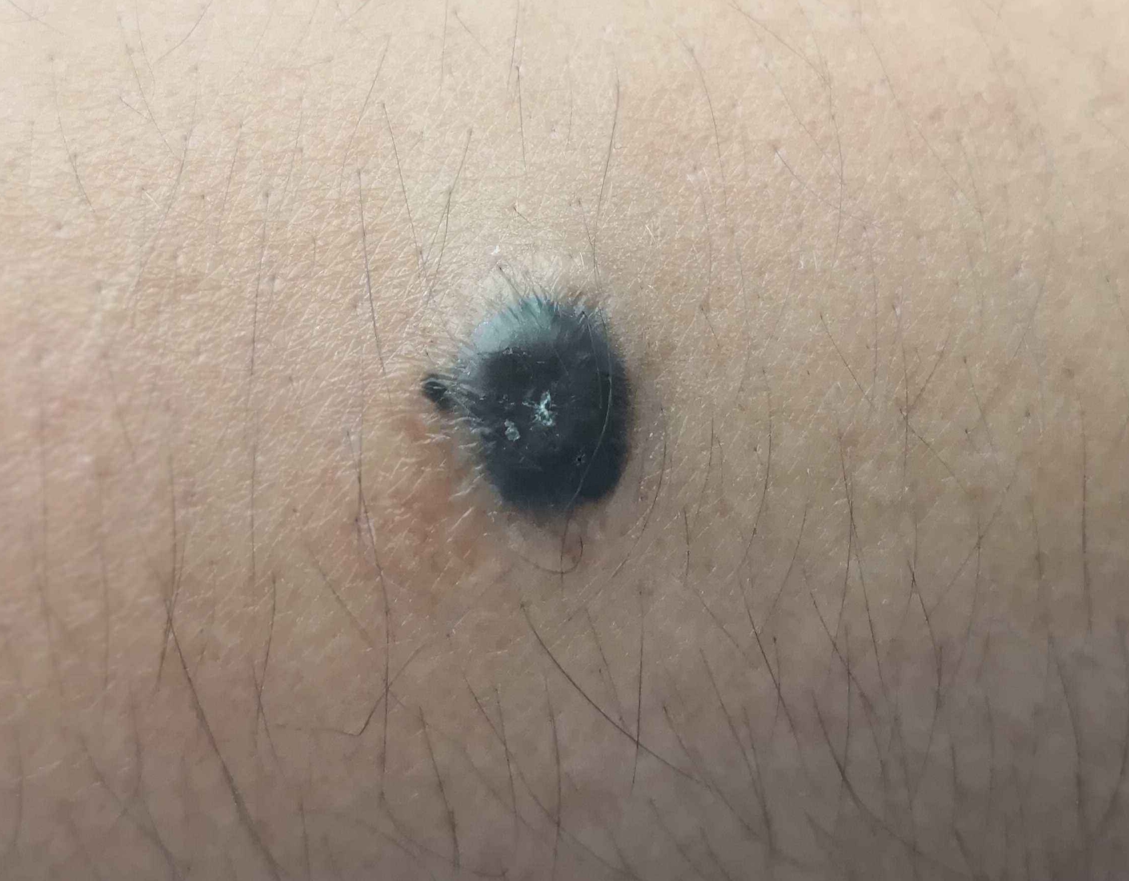 什么是黑痣,蓝痣,太田痣和伊藤痣?_陈子翔_主治医师_爱问健康