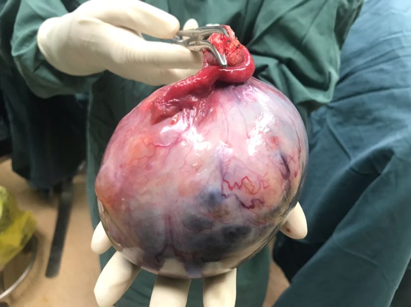 诊间日记:双侧卵巢浆液性囊腺癌