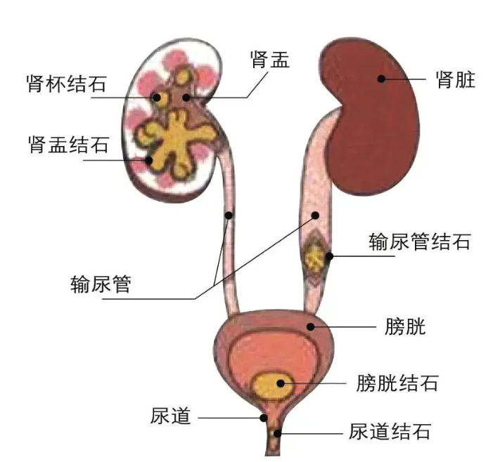 关于泌尿系结石,你知道多少?