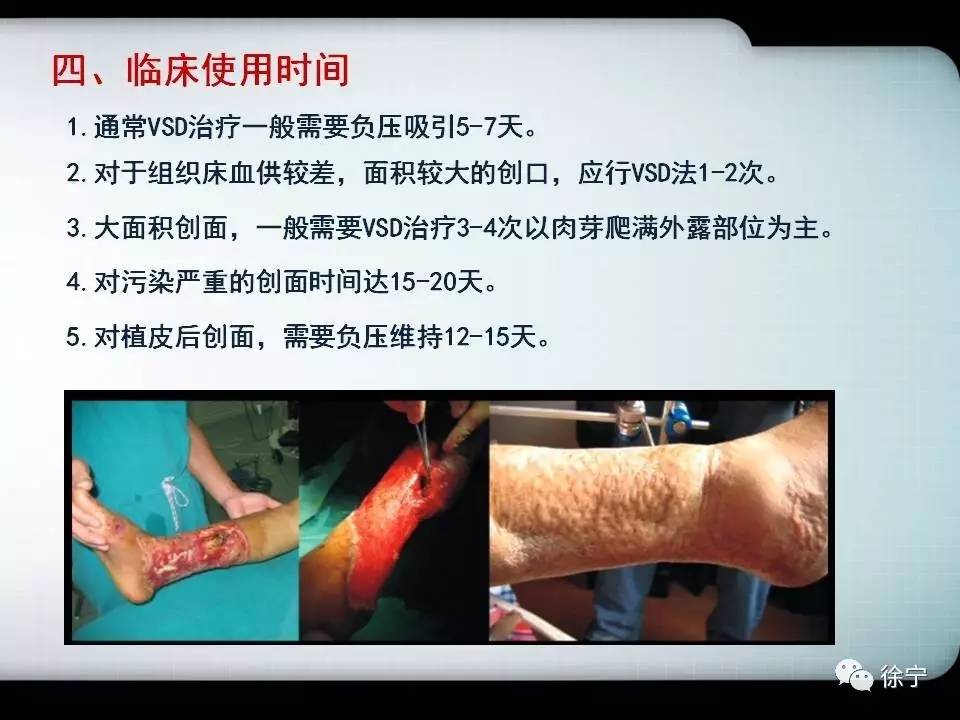 为什么负压引流​负压封闭引流技术VSD_https://www.jmylbn.com_新闻资讯_第6张