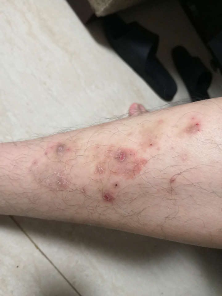 腿上发出这种红色小疙瘩有一年了,非常痒,脚踝部的非常痒,小腿部最近