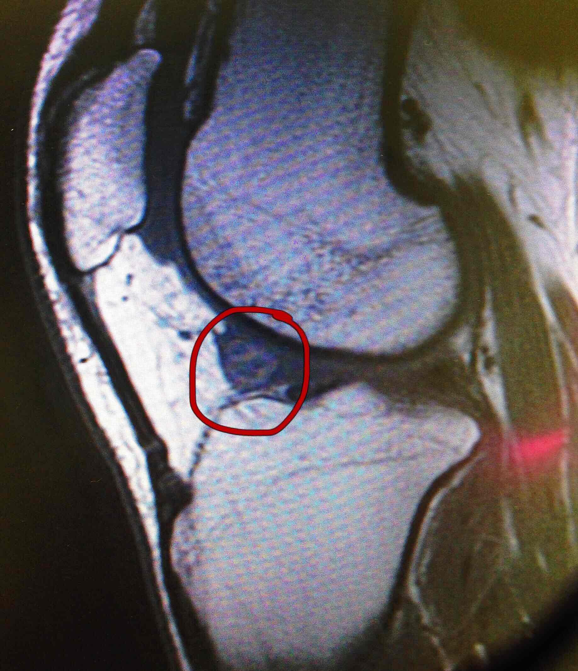 关节内占位导致的关节交锁_周欣_副主任医师_爱问健康