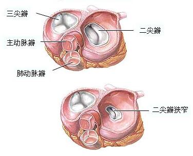 心脏瓣膜病视图图片