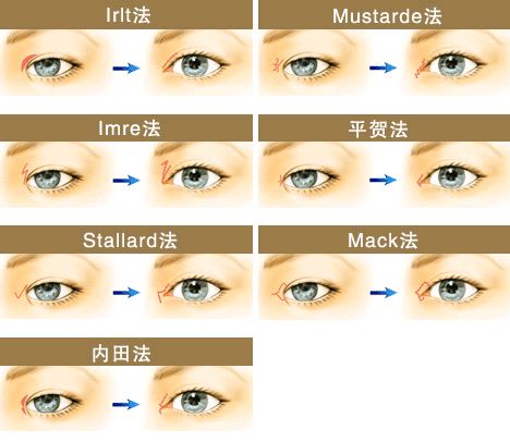 双眼无神问题之内眦赘皮
