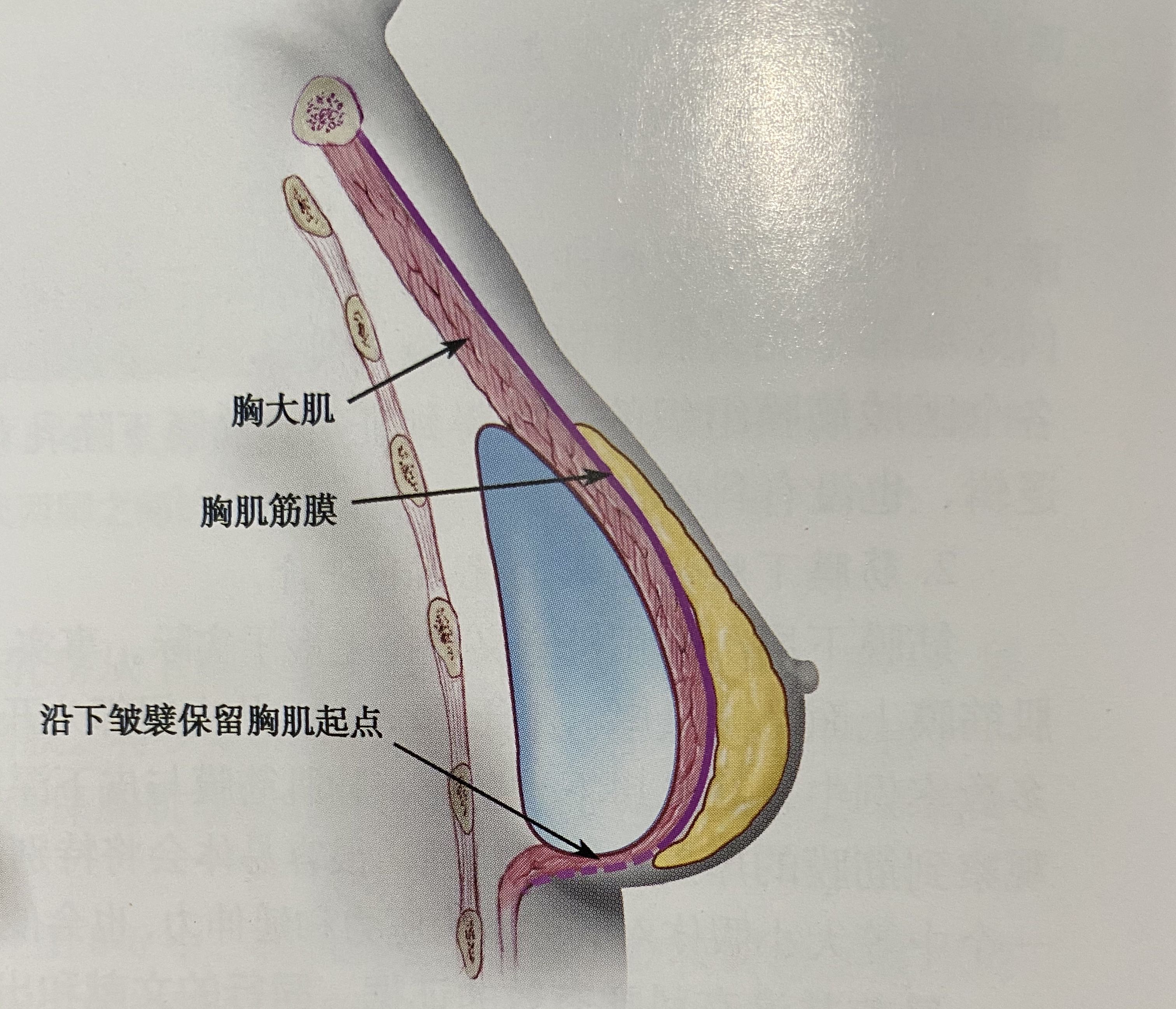 国内假体隆胸手术中几乎有60%都是采用这个层次