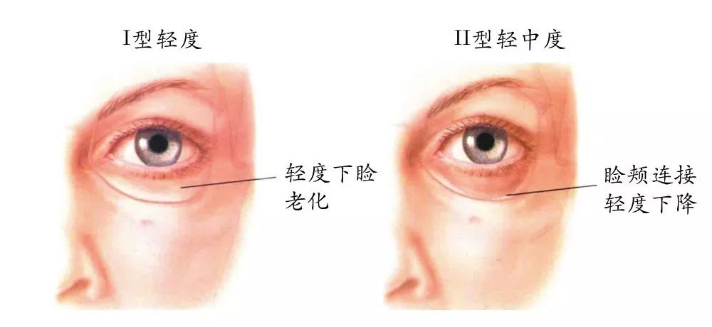 这个部位长肉可真显老,快来看看你有没有?_李远宏_主任医师_爱问健康