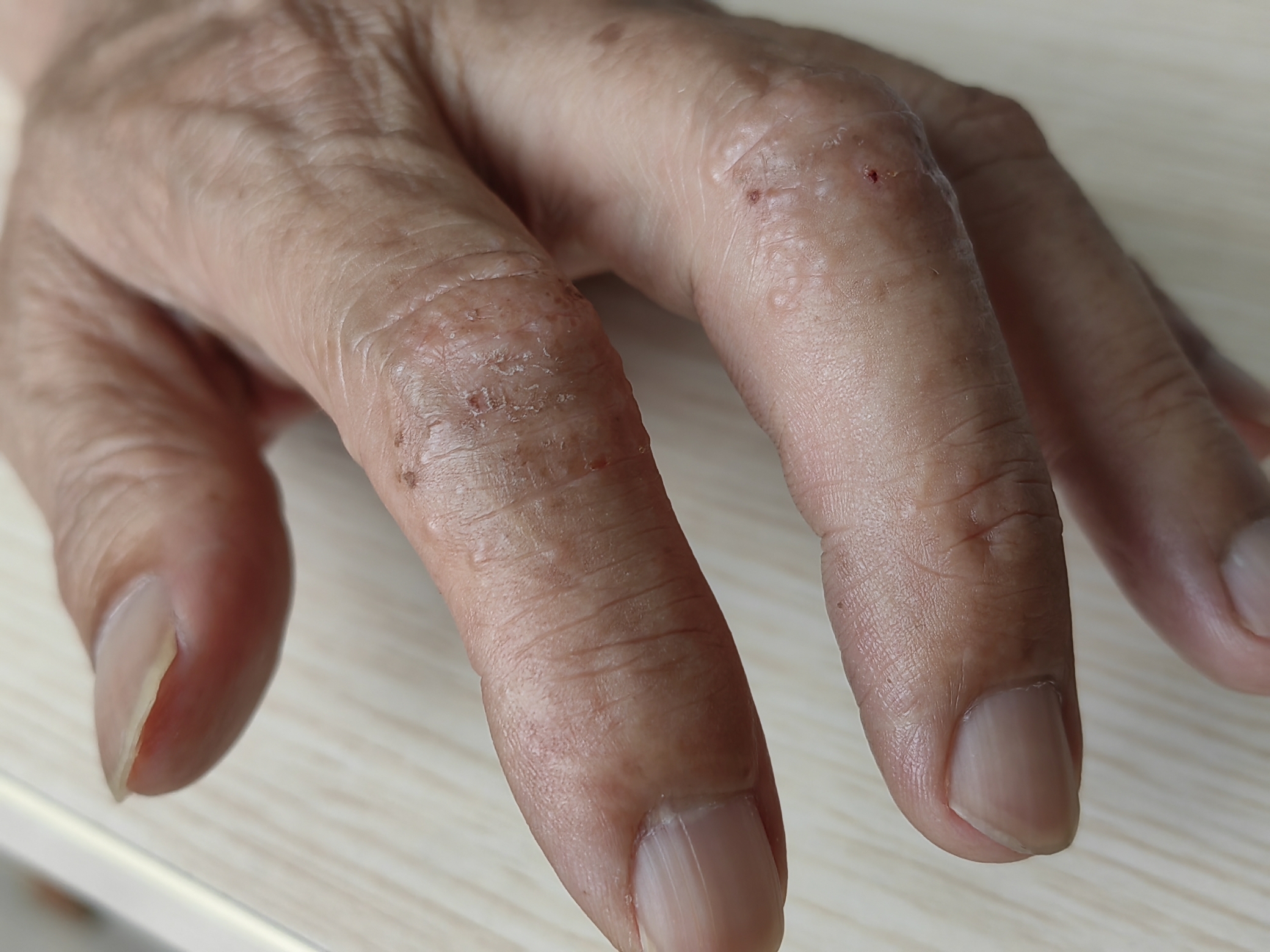 汗疱疹,要注意这两个原因!_朱敏刚_主任医师_爱问健康