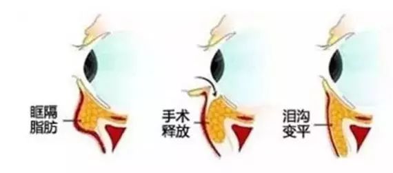 泪沟如何分型治疗?_陈海良_副主任医师_爱问健康