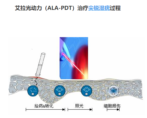 光动力治疗尖锐湿疣效果好吗_刘贵梅_主治医师_爱问健康