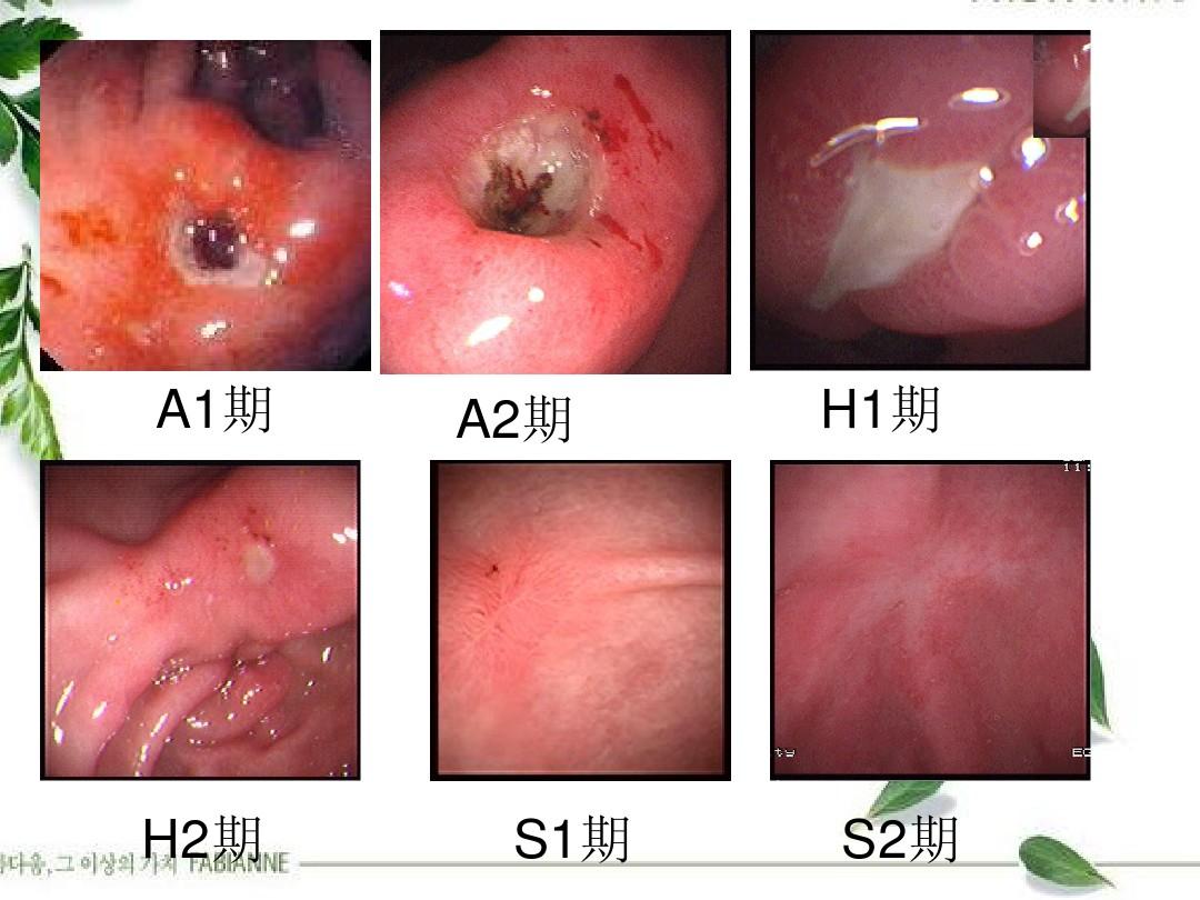 消化性溃疡(胃,十二指肠,食管等)