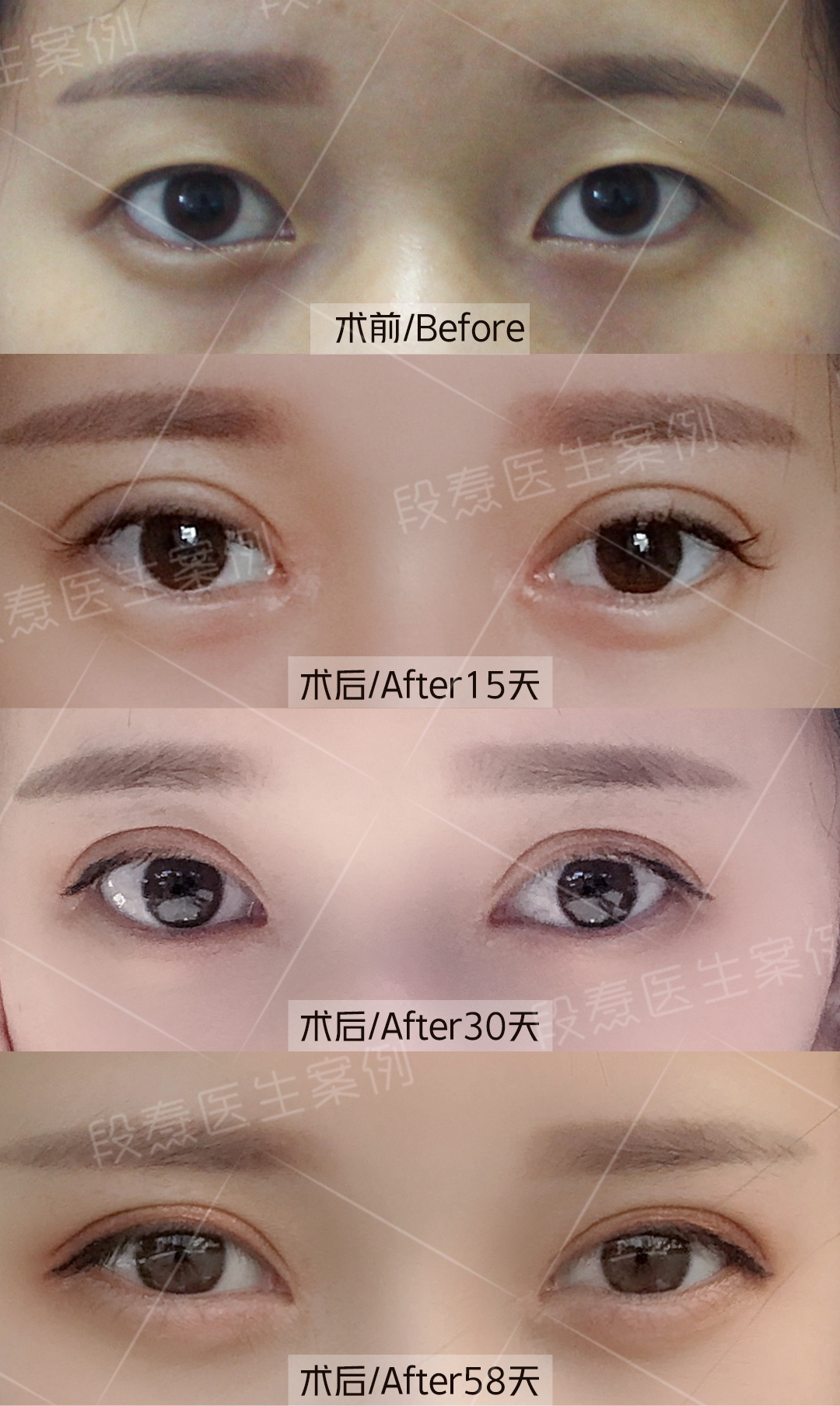 双眼皮术后恢复反馈_段焘_主治医师_爱问健康