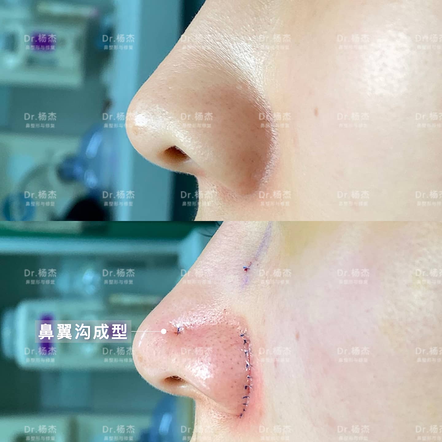 【外切鼻翼缩小+鼻翼沟成型+鼻骨内推】_杨杰_主任医师_爱问健康