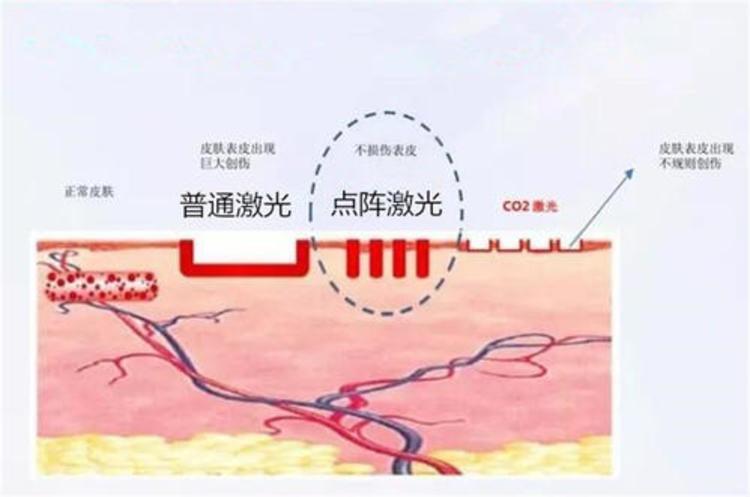 相比传统co2点阵,可以快速让激光能量达到峰值,从而减少对周围皮肤的