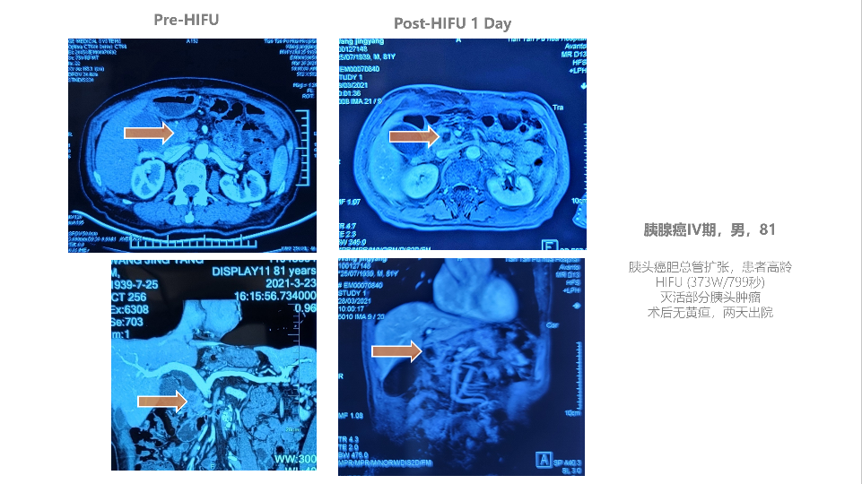 胰腺癌&胰头癌胆总管扩张,81岁高龄_李力军_主任医师_爱问健康