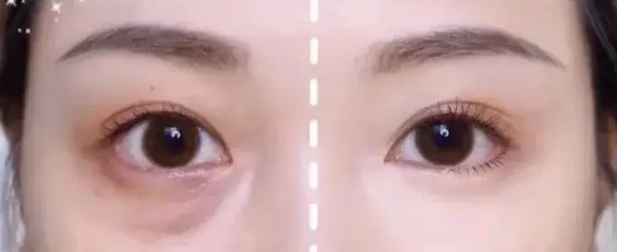 泪沟一出怎样歼灭?_杜太超_副主任医师_爱问健康