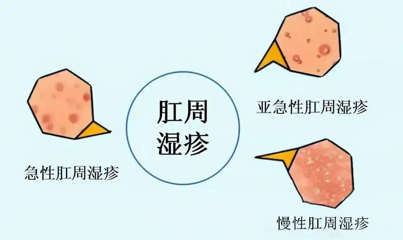 一个让人坐卧不安的皮肤问题肛周湿疹