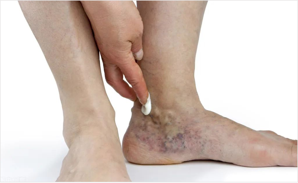 老年人静脉曲张瘙痒,出血,怎么锻炼与恢复?