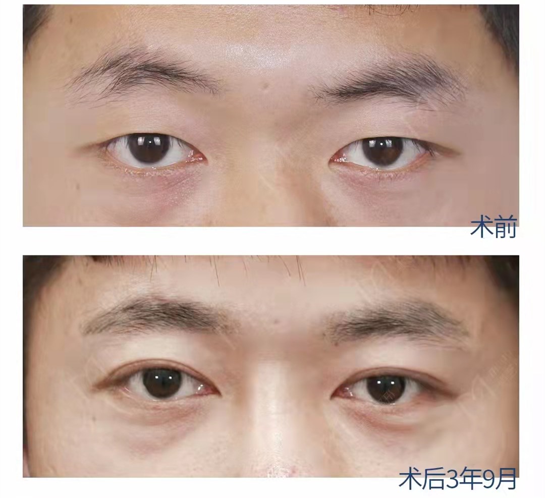 男生做双眼皮需要注意哪些细节?这4点很重要,建议大家收藏。_孔宇_主任医师_爱问健康