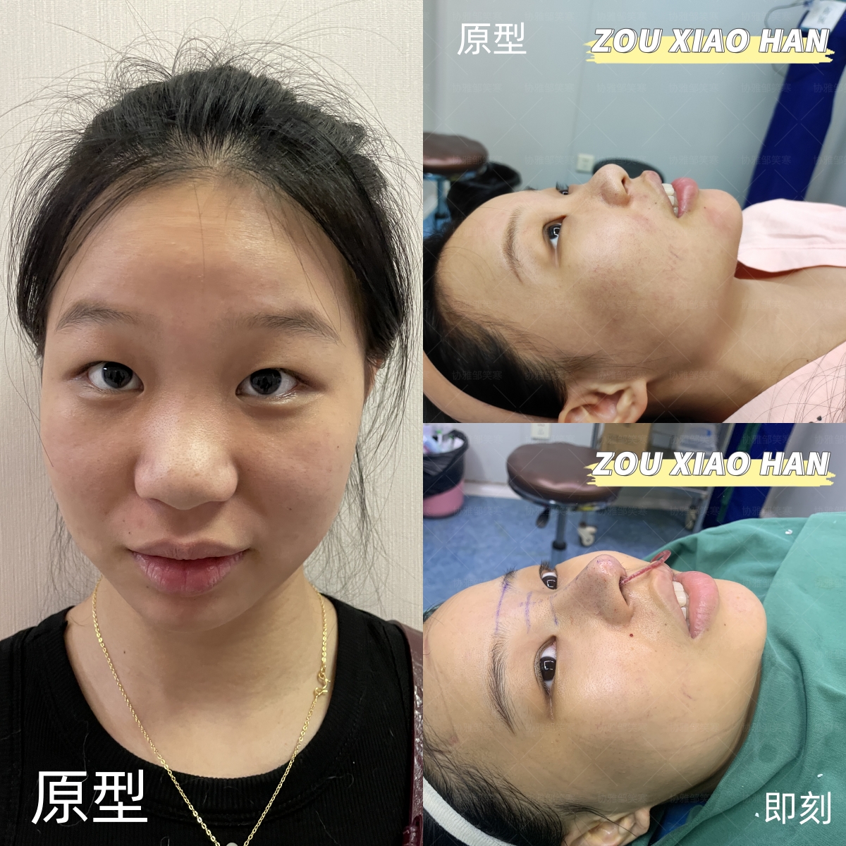 do鼻子，鼻尖一般用什么材料?_邹笑寒_副主任医师_爱问健康