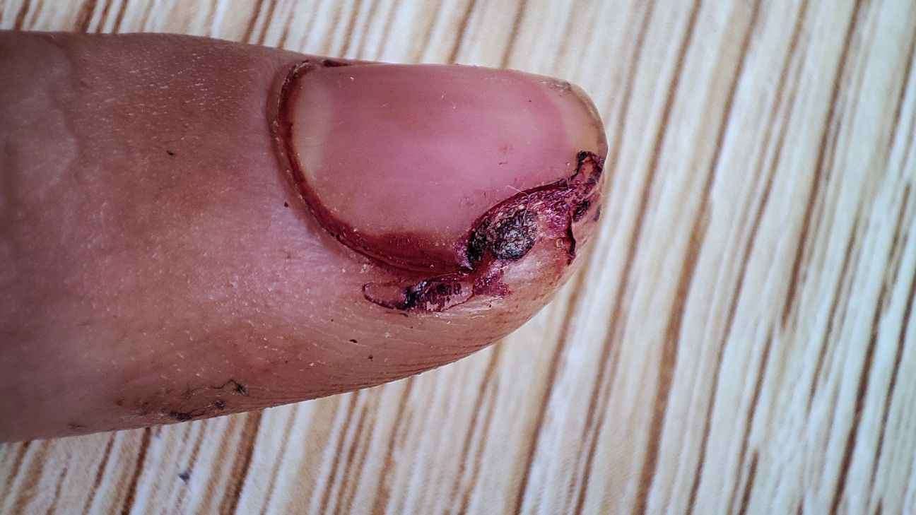 指甲被刀切掉一块何时复原_黄捷_主任医师_爱问健康