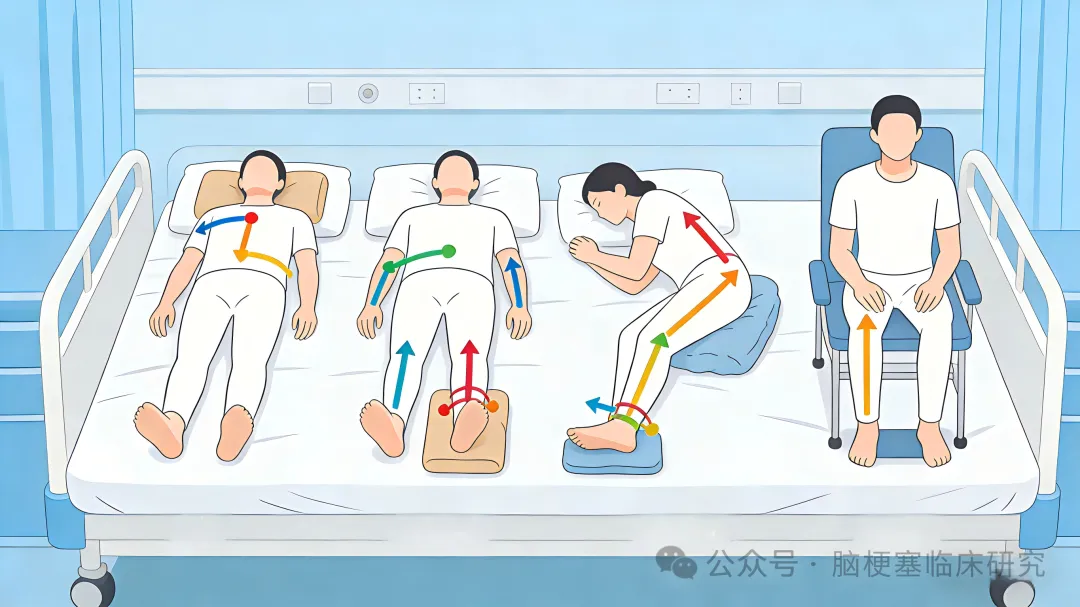 脑卒中软瘫期:别让手脚“瘫着”,这样康复更关键_张广柱_副主任医师_爱问健康