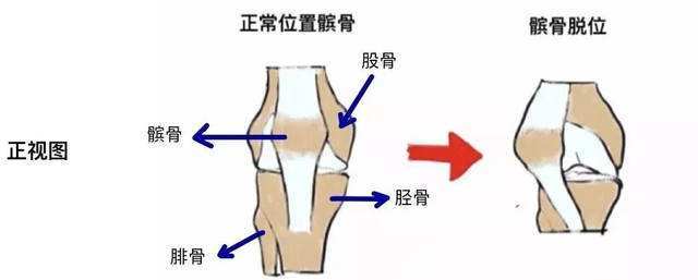 腿不直还膝盖痛?膝关节第一杀手【Q角】了解一下_陈博闻__爱问健康