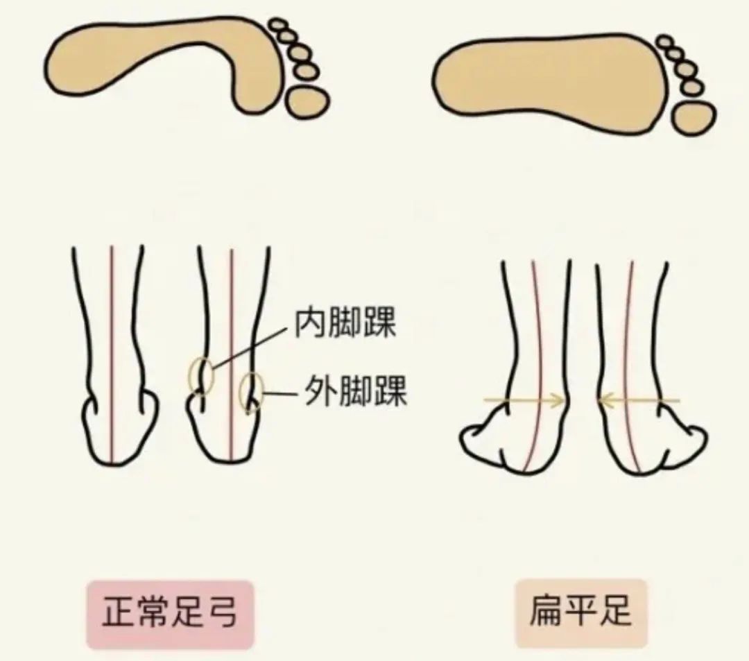 科学解读下肢力线:如何改善X型腿和O型腿?_陈博闻__爱问健康