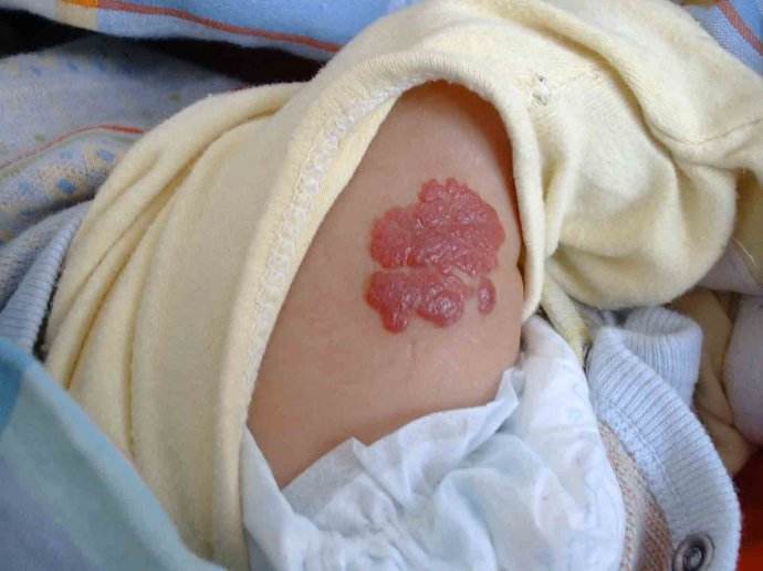 草莓状血管瘤的危害