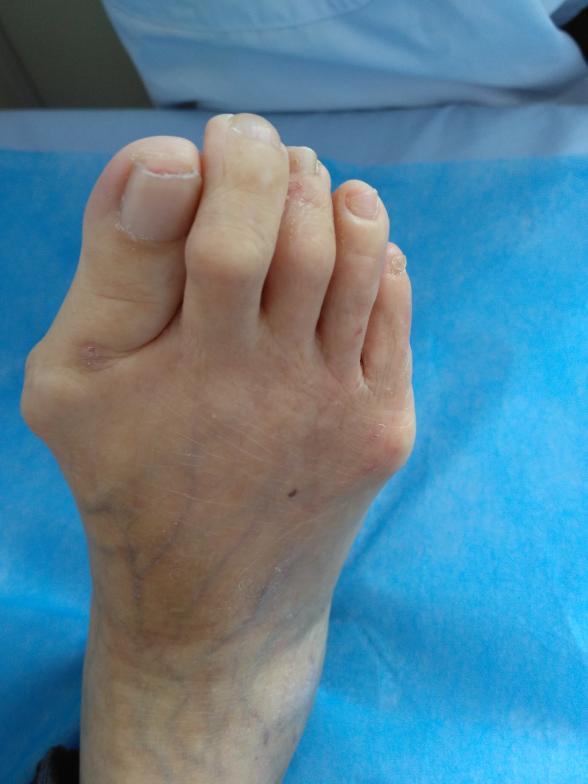 为什么类风湿患者的痛会很痛