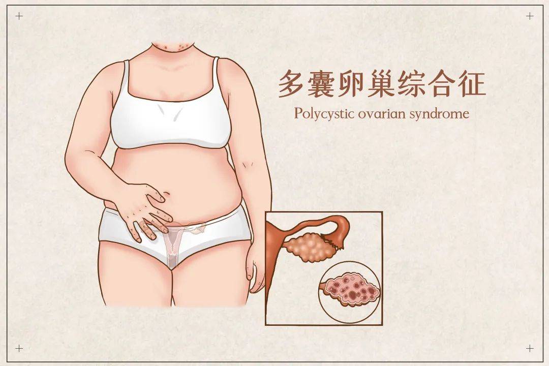 多囊卵巢减肥_多囊卵巢减肥后可以自愈吗