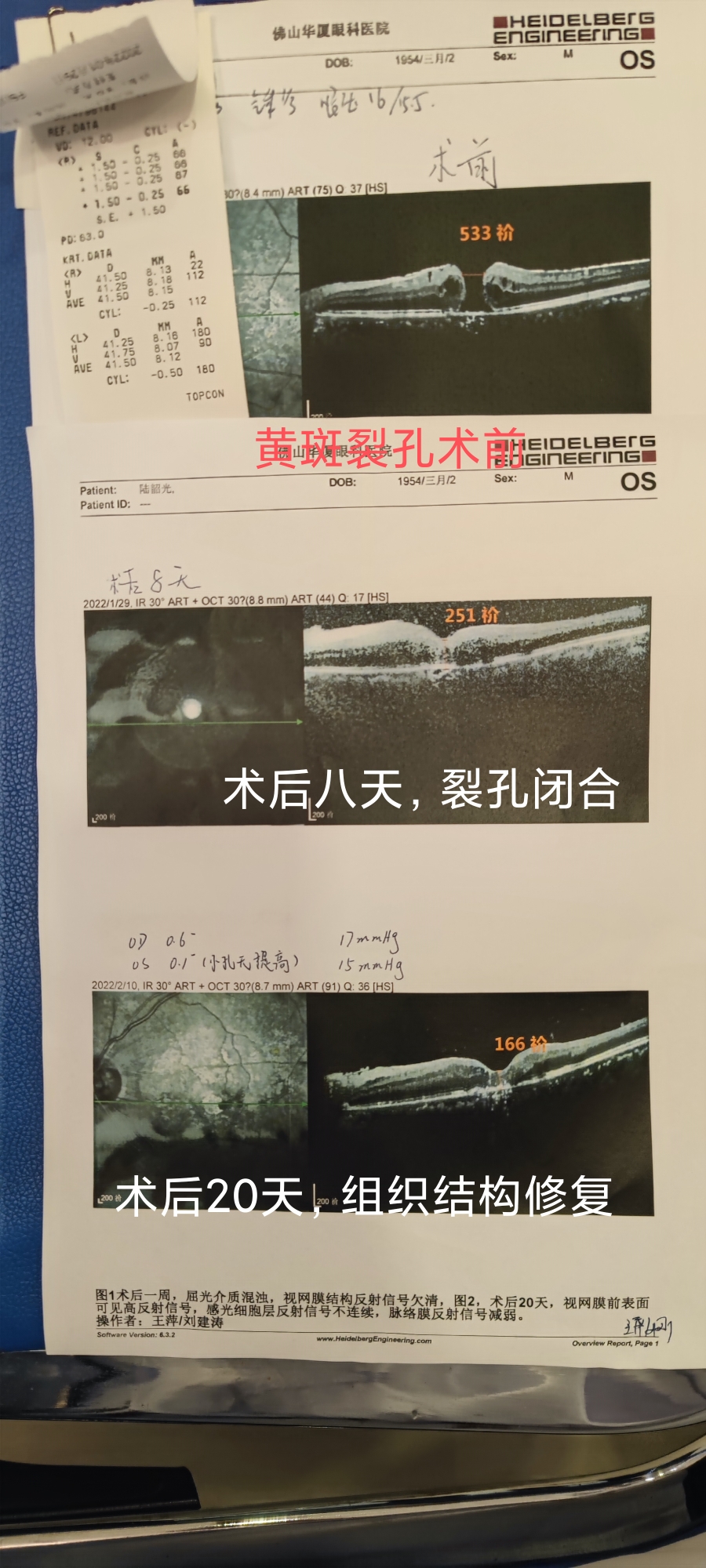 最好在发生黄斑牵拉,黄斑前膜,还没有发展成黄斑裂孔阶段,就手术治疗.