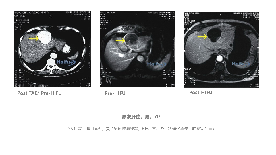 肝癌介入栓塞后碘油沉积 复查发现肿瘤残留_李力军_主任医师_爱问健康