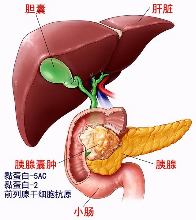 胰腺囊肿分类及相关症状介绍